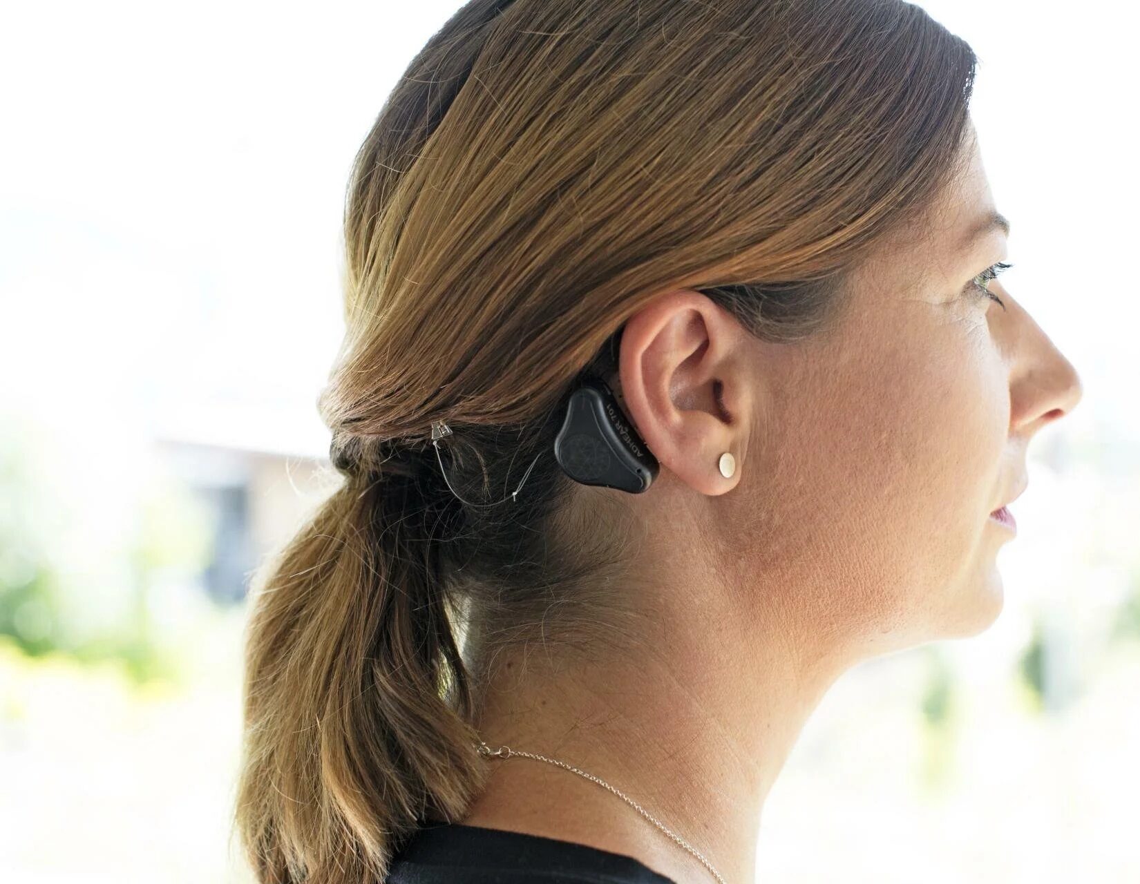 ADHEAR Bone Conduction System
